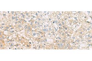 Immunohistochemistry of paraffin-embedded Human liver cancer tissue using EIF4E2 Polyclonal Antibody at dilution of 1:50(x200) (EIF4E2 抗体)