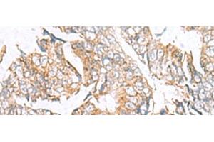 Immunohistochemistry of paraffin-embedded Human colorectal cancer tissue using GPC2 Polyclonal Antibody at dilution of 1:40(x200) (GPC2 抗体)