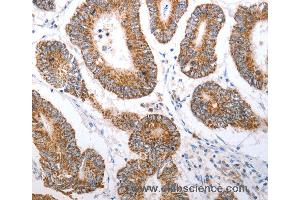 Immunohistochemistry of Human liver cancer using HCRTR1 Polyclonal Antibody at dilution of 1:70 (HCRTR1 抗体)