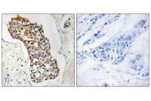 Immunohistochemistry analysis of paraffin-embedded human breast carcinoma tissue, using HSD11B1 antibody. (HSD11B1 抗体  (N-Term))
