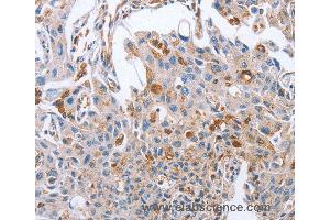 Immunohistochemistry of Human cervical cancer using NRG4 Polyclonal Antibody at dilution of 1:60 (Neuregulin 4 抗体)