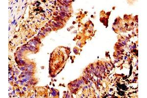 IHC image of ABIN7148983 diluted at 1:400 and staining in paraffin-embedded human lung cancer performed on a Leica BondTM system. (CSTA 抗体  (AA 2-98))