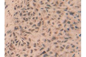 DAB staining on IHC-P; Samples: Human Lung cancer Tissue (TRAF5 抗体  (AA 181-437))