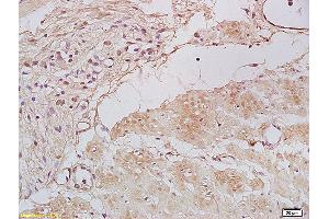 Formalin-fixed and paraffin embedded human gastric carcinoma labeled with Anti Tbx21/T-bet Polyclonal Antibody, Unconjugated (ABIN701395) at 1:200 followed by conjugation to the secondary antibody and DAB staining. (T-Bet 抗体)