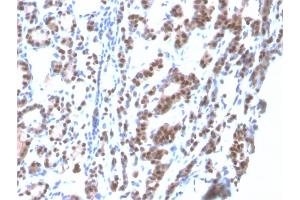 Formalin-fixed, paraffin-embedded human Thyroid stained with TTF-1 Mouse Recombinant Monoclonal Antibody (rNX2. (Recombinant NKX2-1 抗体)
