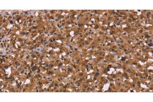 Immunohistochemistry of paraffin-embedded Human thyroid cancer using HDLBP Polyclonal Antibody at dilution of 1:50 (HDLBP 抗体)