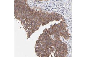 Immunohistochemical staining of human urinary bladder with PPFIBP2 polyclonal antibody  shows strong cytoplasmic positivity in urothelial cells at 1:50-1:200 dilution. (PPFIBP2 抗体)