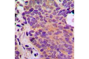 Immunohistochemical analysis of ADPGK staining in human breast cancer formalin fixed paraffin embedded tissue section. (ADPGK 抗体  (Center))
