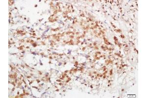 Formalin-fixed and paraffin embedded human lung carcinoma labeled with Rabbit Anti-B MyB Polyclonal Antibody, Unconjugated (ABIN760406) at 1:200 followed by conjugation to the secondary antibody and DAB staining (MYBL2 抗体  (AA 101-200))