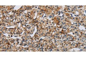 Immunohistochemistry of paraffin-embedded Human prostate cancer tissue using PERK Polyclonal Antibody at dilution 1:50 (PERK 抗体)