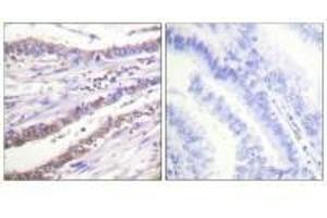 Immunohistochemical analysis of paraffin-embedded human lung carcinoma tissue using Cyclin A antibody. (Cyclin A1 抗体)