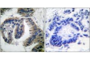 Immunohistochemistry analysis of paraffin-embedded human lung carcinoma tissue, using HSP40 Antibody. (DNAJB1 抗体  (AA 271-320))