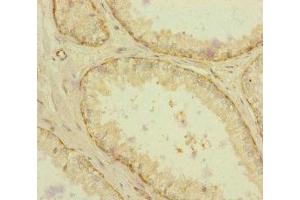 Immunohistochemistry of paraffin-embedded human prostate cancer using ABIN7167234 at dilution of 1:100 (RAB18 抗体  (AA 1-206))