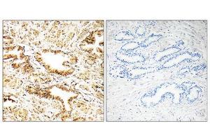 Immunohistochemistry analysis of paraffin-embedded human prostate carcinoma tissue, using CAMKK2 antibody.