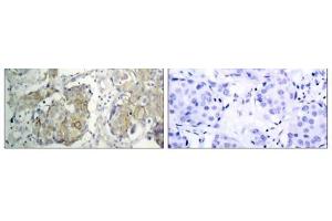 Immunohistochemical analysis of paraffin-embedded human breast carcinoma tissue, using V (VEGFR2/CD309 抗体  (pTyr1214))