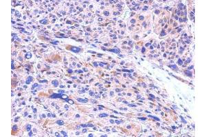 IHC-P Image CBR1 antibody [C2C3], C-term detects CBR1 protein at cytosol on human hepatoma by immunohistochemical analysis. (CBR1 抗体  (C-Term))