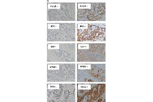 Immunostaining of EGFR ligands and co-expression with wtEGFR in mCRC specimensExpression of Amphiregulin, BTC, EGF, Epigen, and TGFα (A), and co-expression of wtEGFR, Amphiregulin, BTC, EGF, epigen, and TGFα in a particular patient (B) in formalin fixed paraffin embedded tumour sections stained immunohistochemically as described under methods and patients section. (Amphiregulin 抗体)