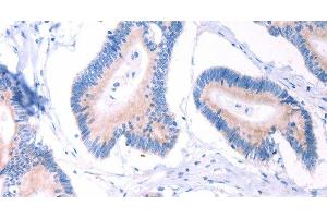 Immunohistochemistry of paraffin-embedded Human colon cancer using AADAC Polyclonal Antibody at dilution of 1:30 (AADAC 抗体)