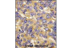 Formalin-fixed and paraffin-embedded human breast carcinoma tissue reacted with DKK3 Antibody (N-term), which was peroxidase-conjugated to the secondary antibody, followed by DAB staining. (DKK3 抗体  (N-Term))