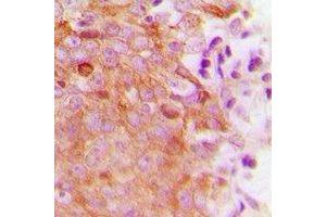 Immunohistochemical analysis of MRRF staining in human breast cancer formalin fixed paraffin embedded tissue section. (MRRF 抗体  (C-Term))