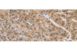 Immunohistochemistry of paraffin-embedded Human liver cancer tissue using ZIC2 Polyclonal Antibody at dilution of 1:100(x200) (ZIC2 抗体)