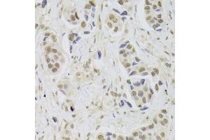 Immunohistochemistry of paraffin-embedded human breast cancer using UBE3C Antibody. (UBE3C 抗体)