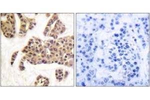 Immunohistochemistry analysis of paraffin-embedded human breast carcinoma, using BAD (Phospho-Ser91/128) Antibody. (BAD 抗体  (pSer91))