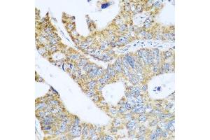 Immunohistochemistry of paraffin-embedded human colon carcinoma using GLUD1 antibody. (GLUD1 抗体  (AA 54-240))