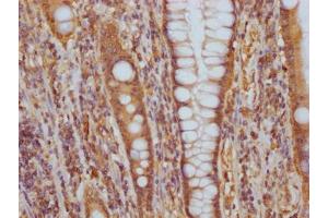 IHC image of ABIN7127577 diluted at 1:100 and staining in paraffin-embedded human colon cancer performed on a Leica BondTM system. (Recombinant CD51 抗体)