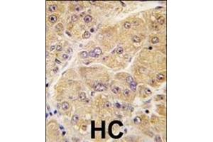 Formalin-fixed and paraffin-embedded human hepatocarcinoma tissue reacted with SOST antibody (Center) (ABIN390194 and ABIN2840683) , which was peroxidase-conjugated to the secondary antibody, followed by DAB staining. (Sclerostin 抗体  (AA 134-163))