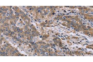 Immunohistochemistry of paraffin-embedded Human liver cancer tissue using GSN Polyclonal Antibody at dilution 1:40 (Gelsolin 抗体)