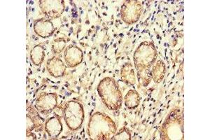 Immunohistochemistry of paraffin-embedded human gastric cancer using ABIN7160084 at dilution of 1:100 (BUB1 抗体  (AA 256-577))