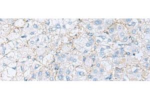 Immunohistochemistry of paraffin-embedded Human liver cancer tissue using EMILIN1 Polyclonal Antibody at dilution of 1:70(x200) (Emilin1 抗体)