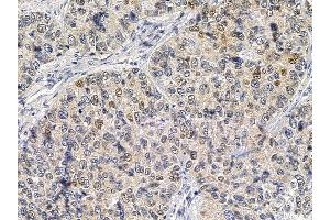 SQSTM1/p62 Mouse Monoclonal Antibody at 1/100 staining human lung cancer by IHC-P. (SQSTM1 抗体  (C-Term))