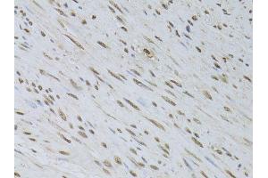 Immunohistochemistry of paraffin-embedded human uterine cancer using HDGFRP3 antibody (ABIN5995765) at dilution of 1/100 (40x lens). (HDGFRP3 抗体)