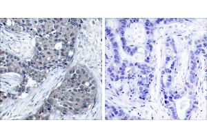 P-Peptide - +Immunohistochemical analysis of paraffin-embedded human breast carcinoma tissue using elF4E (phospho- Ser209) antibody. (EIF4E 抗体  (pSer209))