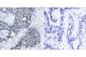P-Peptide - +Immunohistochemical analysis of paraffin-embedded human breast carcinoma tissue using elF4E (phospho- Ser209) antibody.
