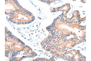 The image on the left is immunohistochemistry of paraffin-embedded Human colon cancer tissue using ABIN7128444(AOC1 Antibody) at dilution 1/15, on the right is treated with fusion protein. (DAO 抗体)