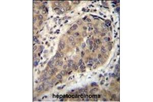 WTIP Antibody (C-term) (ABIN655782 and ABIN2845217) immunohistochemistry analysis in formalin fixed and paraffin embedded human hepatocarcinoma followed by peroxidase conjugation of the secondary antibody and DAB staining.