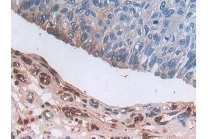 Detection of DEFa3 in Human Prostate cancer Tissue using Polyclonal Antibody to Defensin Alpha 3, Neutrophil Specific (DEFa3) (DEFa3 抗体  (AA 21-94))