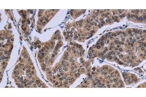 Immunohistochemistry of paraffin-embedded Human breast cancer tissue using IPO8 Polyclonal Antibody at dilution 1:50 (Importin 8 抗体)