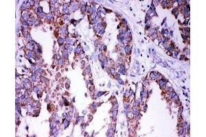 IHC-P: DISC1 antibody testing of human lung cancer tissue (DISC1 抗体  (Middle Region))