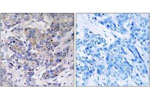 Immunohistochemistry analysis of paraffin-embedded human breast carcinoma tissue, using RPS21 Antibody. (RPS21 抗体  (AA 31-80))