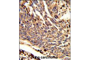 Formalin-fixed and paraffin-embedded human lung carcinoma reacted with ARPC1B Antibody , which was peroxidase-conjugated to the secondary antibody, followed by DAB staining. (ARPC1B 抗体  (AA 159-188))