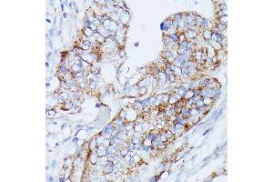 Immunohistochemistry of paraffin-embedded human colon carcinoma using MANBA antibody (ABIN7268392) at dilution of 1:100 (40x lens). (MANBA 抗体  (AA 18-300))