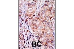 Formalin-fixed and paraffin-embedded human cancer tissue reacted with the primary antibody, which was peroxidase-conjugated to the secondary antibody, followed by AEC staining. (TRIB3 抗体  (N-Term))