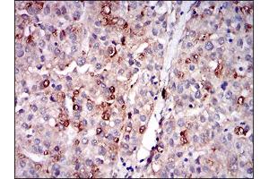 Immunohistochemical analysis of paraffin-embedded liver cancer tissues using PLIN2 mouse mAb with DAB staining. (ADRP 抗体  (AA 286-437))