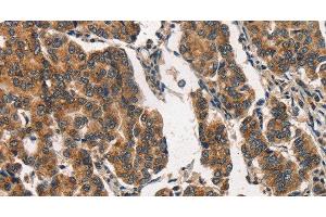Immunohistochemistry of paraffin-embedded Human breast cancer using ITGA2 Polyclonal Antibody at dilution of 1:30