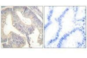 Immunohistochemical analysis of paraffin-embedded human colon carcinoma tissue using Gastrin antibody. (Gastrin 抗体)