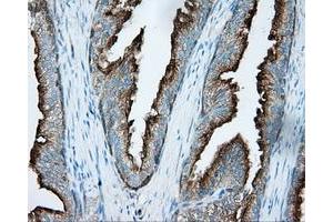 Immunohistochemical staining of paraffin-embedded Carcinoma of liver tissue using anti-PRKAR2A mouse monoclonal antibody. (PRKAR2A 抗体)